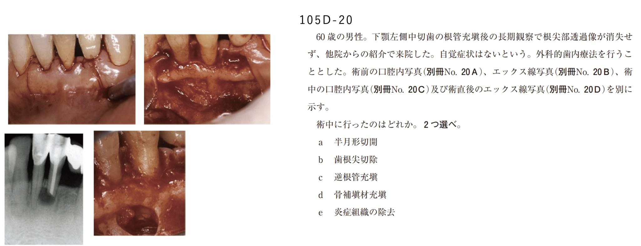 外科的歯内療法｜歯科オンラインセミナー・録画配信は1D（ワンディー）