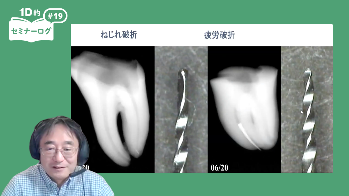 1D的セミナーログ】絶対にできる、ファイル破折・根管内異物への対応法
