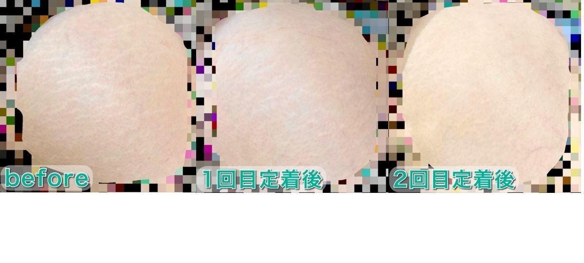 肉割れ、アートメイク