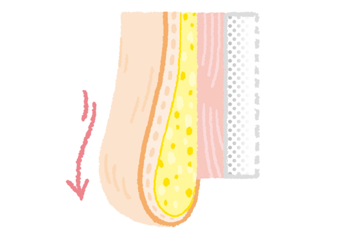 弾力を失った肌は重力でみるみる垂れ下がる