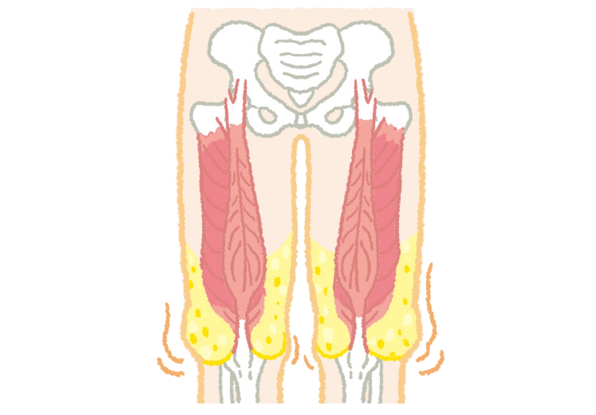 大腿四頭筋がひざ頭を支えきれず垂れ下がる