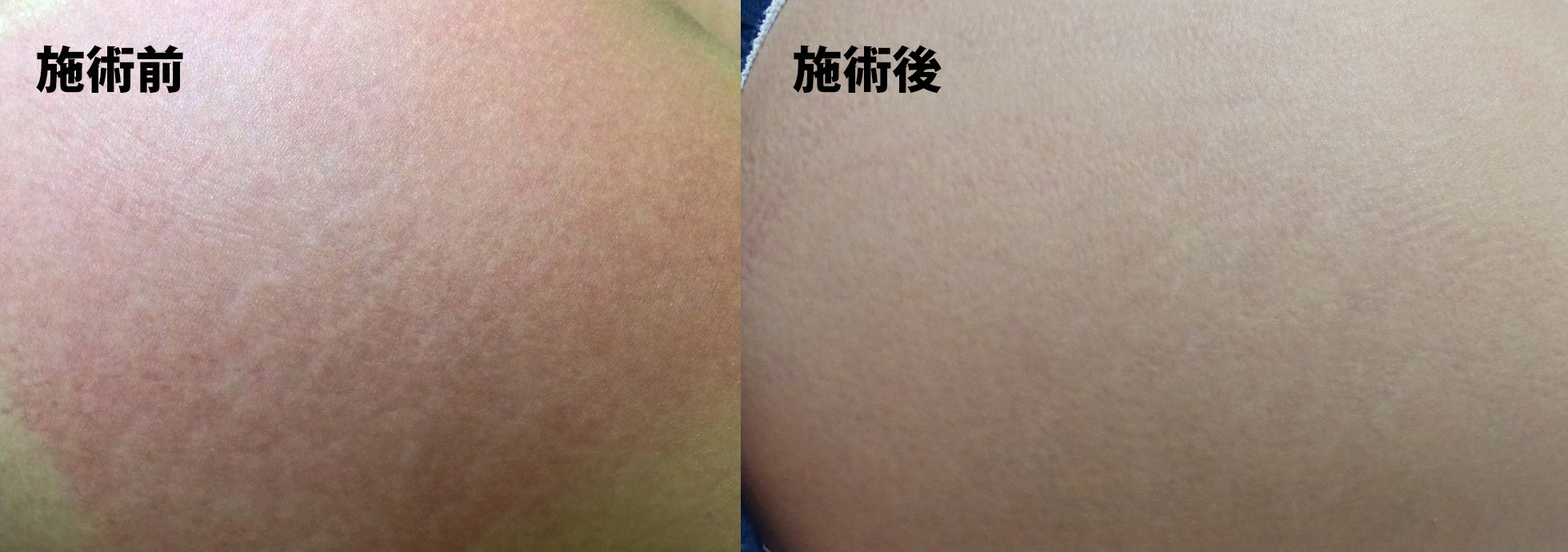 『肉割れ』ができる原因と対策を徹底リサーチ！ GALLERY_1_1