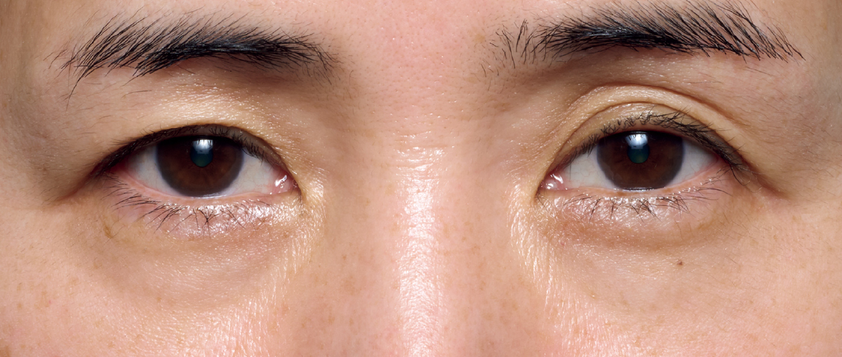 黒ぐま×たるみぐまタイプのくまカバー＆涙袋メイクのテクニック ビフォー