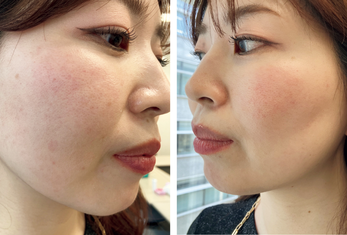 マキア　毛穴ケア　おすすめ　乾燥肌　赤み　肌状態