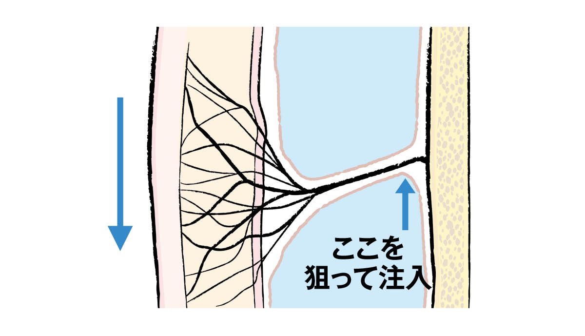 最新美容医療 ヒアルロン酸注入 リガメントを支えて補強する ビフォー