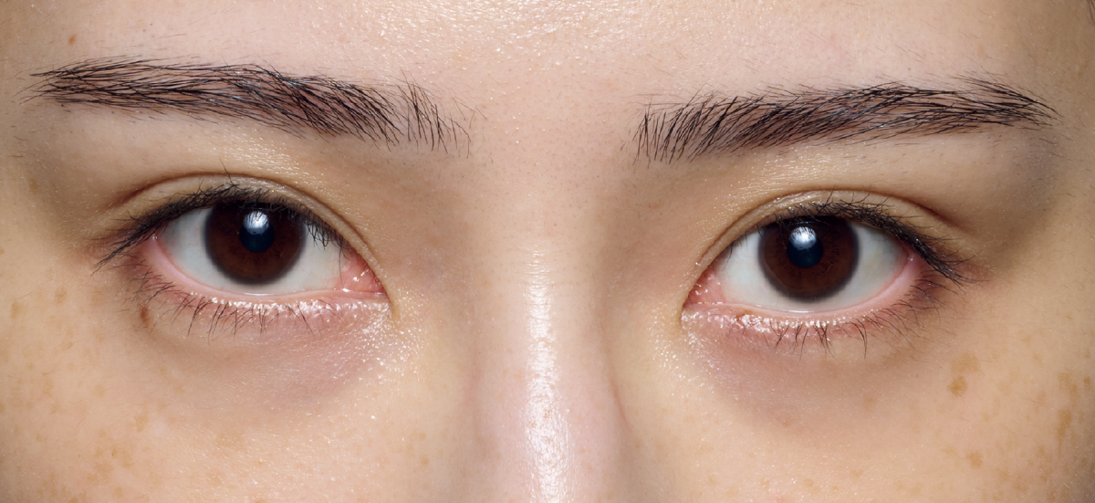 紫ぐまタイプのくまカバー＆涙袋メイクのテクニック ビフォー