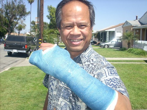 ギプスを付けた左腕を見せる男性