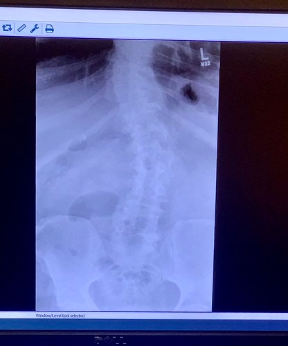 曲がった背骨が写るレントゲン写真