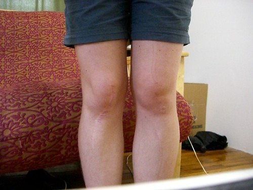 脱臼した人の足