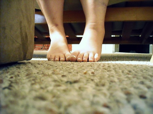 交通事故で骨挫傷をした足