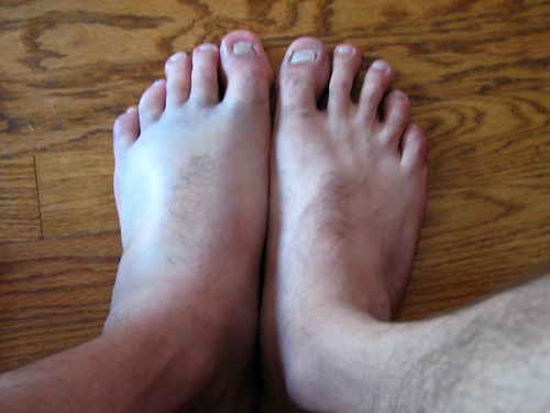 交通事故で骨挫傷をした足