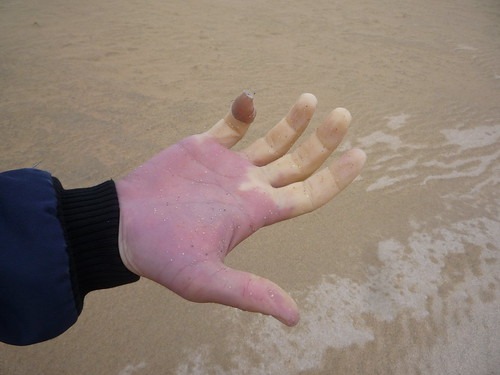 むちうち　早く治す