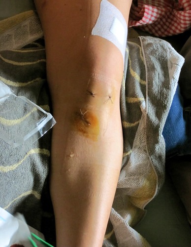 けがで膝を縫合した男性