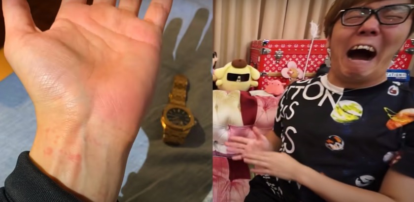 2人揃って金属アレルギーを発症？