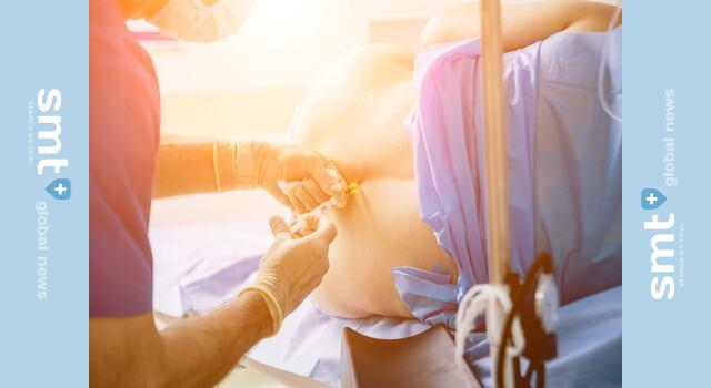 硬膜外カテーテル、13％で位置ずれ？ 経験豊富な医師でも注意が必要 | SMT