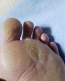 BabyFoot足裏ズルむけコンテスト特別編参加します！