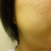 「毛穴・・・すごいです。」モニプラリニューアル記念「毛穴の黒ずみ自慢コンテスト」の投稿画像