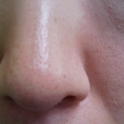 「汚い・・・」モニプラリニューアル記念「毛穴の黒ずみ自慢コンテスト」の投稿画像