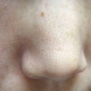 「毛穴をかくしたい！」モニプラリニューアル記念「毛穴の黒ずみ自慢コンテスト」の投稿画像