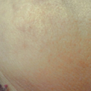 「毛穴も…」モニプラリニューアル記念「毛穴の黒ずみ自慢コンテスト」の投稿画像