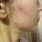 「フェイスラインの治らないニキビをどうにかしたい！！」「ニキビ＆吹き出物」自慢画像コンテスト！【タヒボジャパン株式会社】の投稿画像