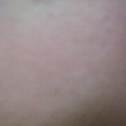 「すっぴんの左頬の･･･わかりずらいけれど」「ニキビ＆吹き出物」自慢画像コンテスト！【タヒボジャパン株式会社】の投稿画像