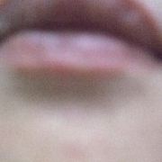 「2枚目･･･（笑）またまた、わかりづらいのですが、顎に・・・」「ニキビ＆吹き出物」自慢画像コンテスト！【タヒボジャパン株式会社】の投稿画像