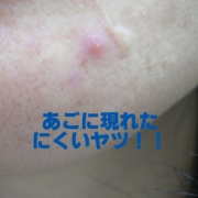 「我が家の頑固なもの、それは・・・」「ニキビ＆吹き出物」自慢画像コンテスト！【タヒボジャパン株式会社】の投稿画像