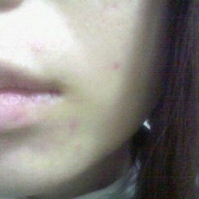 「ニキビとニキビ痕。。。」「ニキビ＆吹き出物」自慢画像コンテスト！【タヒボジャパン株式会社】の投稿画像