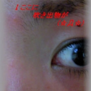 「「ニキビ＆吹き出物」自慢画像コンテスト！」「ニキビ＆吹き出物」自慢画像コンテスト！【タヒボジャパン株式会社】の投稿画像