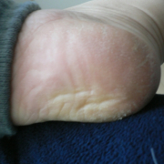 「画像でか！！　かかと汚い！！」【30秒で毛穴黒ずみ・くすみOFF！ピーリング】モニター募集byフューチャーラボの投稿画像