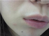 ノーマル唇