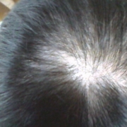 「この状態が 20歳前から…。」髪は女の命！発売前女性向け美髪サプリ★ヘアドルーチェ★じっくり6ヵ月長期モニターの投稿画像