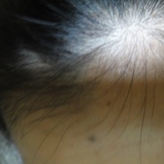 「おでこ」髪は女の命！発売前女性向け美髪サプリ★ヘアドルーチェ★じっくり6ヵ月長期モニターの投稿画像