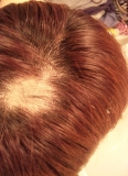 円形脱毛症!!??