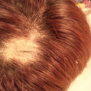 「円形脱毛症!!??」髪は女の命！発売前女性向け美髪サプリ★ヘアドルーチェ★じっくり6ヵ月長期モニターの投稿画像