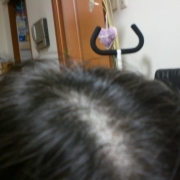 「ぎゃ～～ここまで薄いなんて＞＜」薄いてっぺんのお悩みに。女髪サプリ【ヘアドルーチェ】じっくり３ヵ月モニターの投稿画像