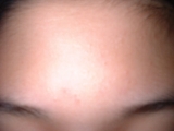 「おでこのにきび」の画像（1枚目）