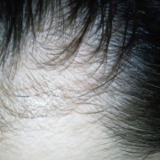 「生え際～」6箱分長期モニター【ＩＧＦ－１育毛理論】の女性専用サプリ「ヘアドルーチェ」の投稿画像