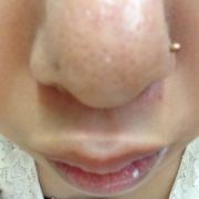 「毛穴」角質ごっそりコンテスト！優勝者にはスキンブライトニングパック5個プレゼント！　の投稿画像