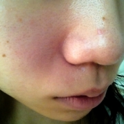 「ひどいお肌…」角質ごっそりコンテスト！優勝者にはスキンブライトニングパック5個プレゼント！　の投稿画像