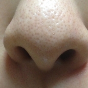 「つまりまくりな小鼻の黒ずみ！」角質ごっそりコンテスト！優勝者にはスキンブライトニングパック5個プレゼント！　の投稿画像