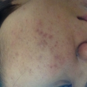 「これで20歳⁈」角質ごっそりコンテスト！優勝者にはスキンブライトニングパック5個プレゼント！　の投稿画像