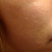 「特に頬が…」角質ごっそりコンテスト！優勝者にはスキンブライトニングパック5個プレゼント！　の投稿画像