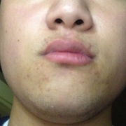 「角質汚れ」角質ごっそりコンテスト！優勝者にはスキンブライトニングパック5個プレゼント！　の投稿画像