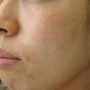 「しみ」こんなシミ隠れましたコンテスト！デルミサ　レーザーコンシーラーの投稿画像