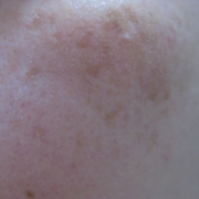 「左右両方にシミがあります」こんなシミ隠れましたコンテスト！デルミサ　レーザーコンシーラーの投稿画像