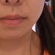 「大きなシミ…」こんなシミ隠れましたコンテスト！デルミサ　レーザーコンシーラーの投稿画像