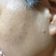 「顔のシワ」こんなシミ隠れましたコンテスト！デルミサ　レーザーコンシーラーの投稿画像