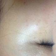 「増え続けるシミ」こんなシミ隠れましたコンテスト！デルミサ　レーザーコンシーラーの投稿画像